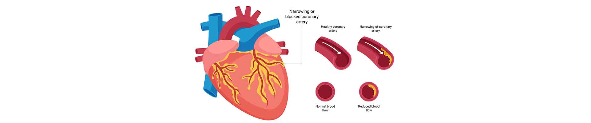 Coronary Artery Disease